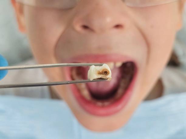 Best Emergency Wisdom Teeth Removal in Grapeland, TX